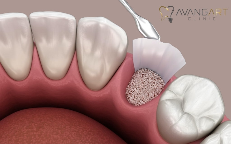 Bone-Graft-For-Dental-Implant