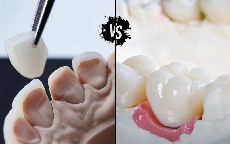 Crowns VS Veneers