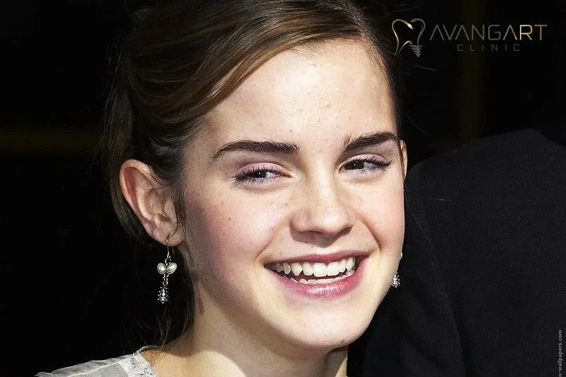 Emma-Watson-Veneers-before-after