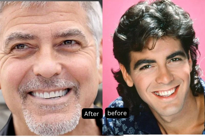 George Clooney Veneers Before and After