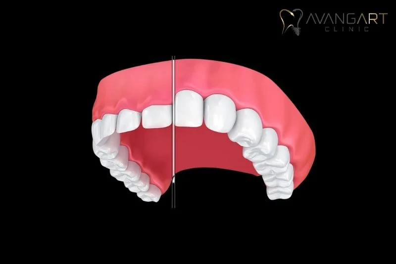 Gum-Contouring-Cost-Benefit-and-Process-in-Turkey