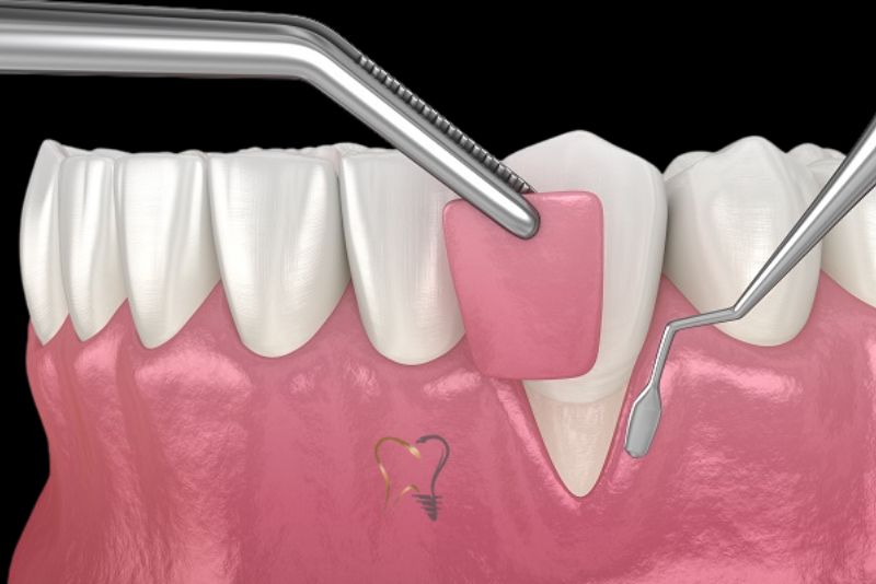 Gum Graft Alternatives