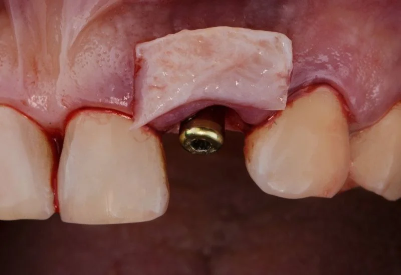 Gum-Graft-Failed
