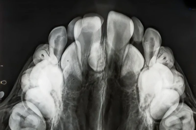 Hyperdontia X-ray