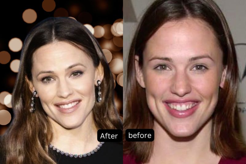 Jennifer Garner Veneers Before and After