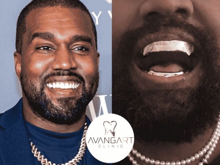 Kanye-West-New-Teeth-Worth-850K-Titanium-Dentures