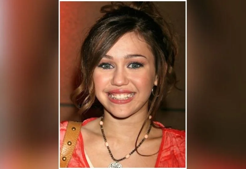 Miley-Cyrus-Veneers-Before
