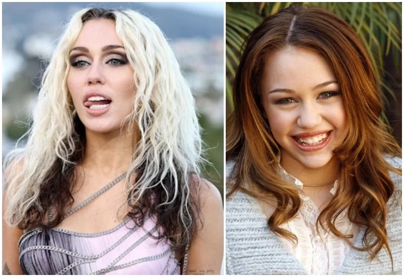 Miley-Cyrus-Veneers-The-Secret-Behind-Her-Hollywood-Smile-Transformation