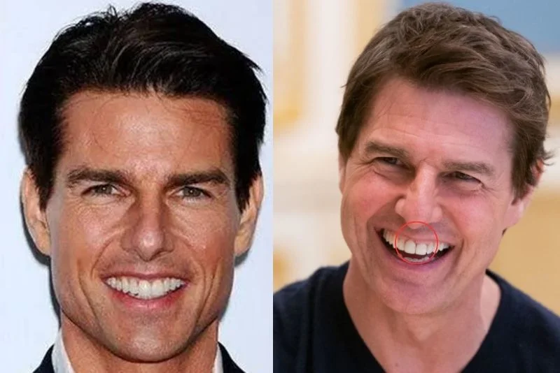 Tom-Cruise-Teeth-Veeners