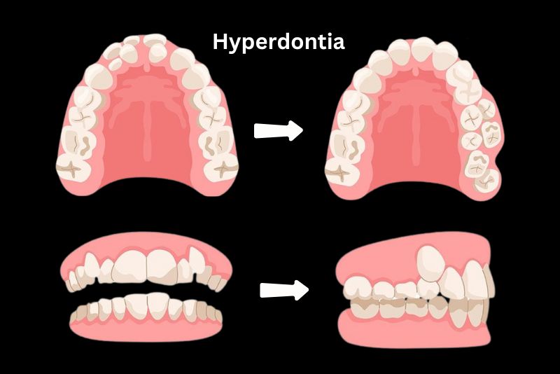 What Is Hyperdontia