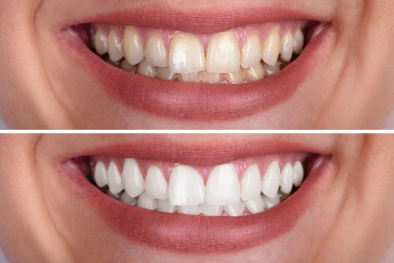 Yellow-Teeth-Vs-White-Teeths