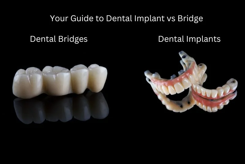 Your Guide to Dental Implant vs Bridge