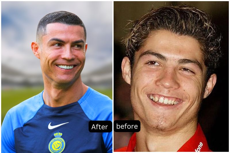 cristiano-ronaldo-before-and-after-his-veneers