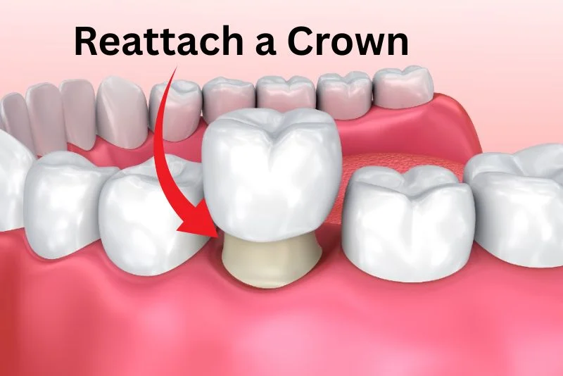 how much does it cost to reattach a crown