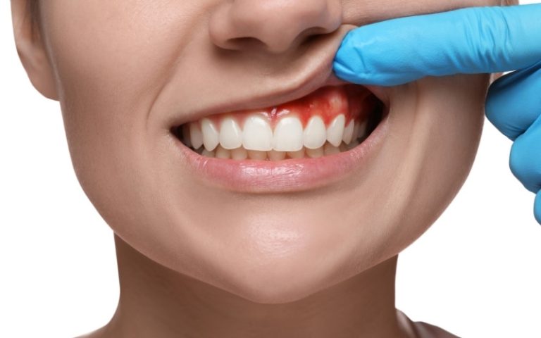 white gums around teeth