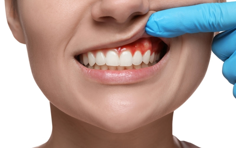white gums around teeth