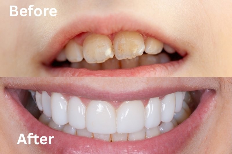 Get Rid Of White Spots On Teeth