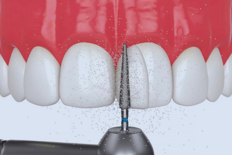 composite bonding