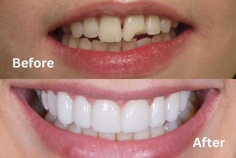 What is composite bonding
