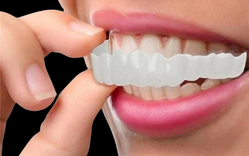 clip on veneers