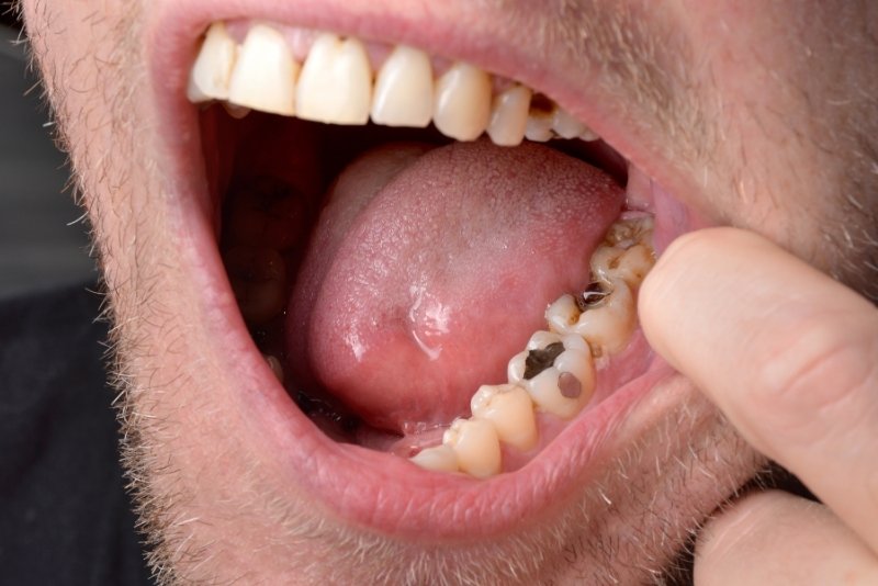 how do you fix rotten teeth
