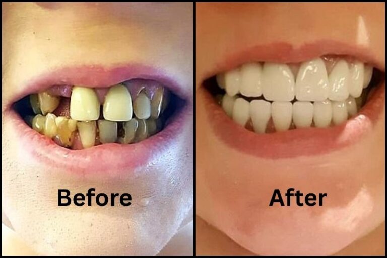 How Do You Fix Rotten Teet Cavities And Tooth Decay