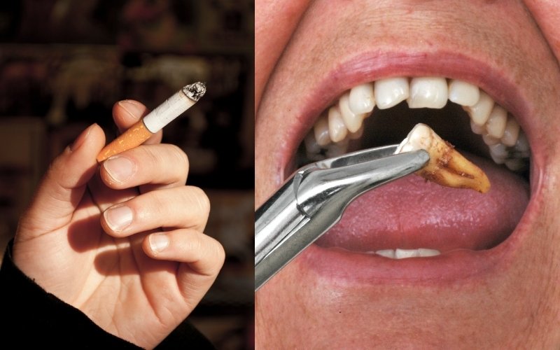 smoking after tooth extraction