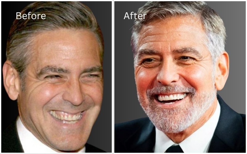 George Clooney Before and After Teeth