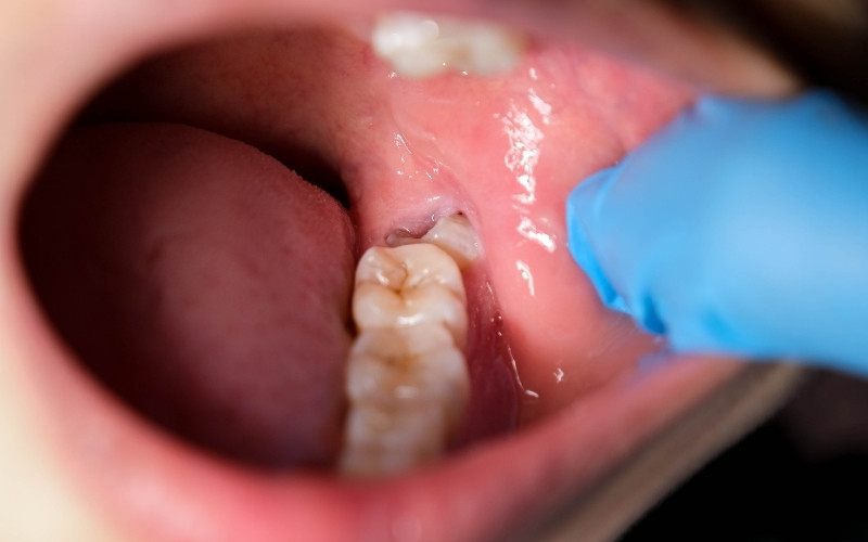 How Do I Know If My Wisdom Teeth Are Coming In Correctly