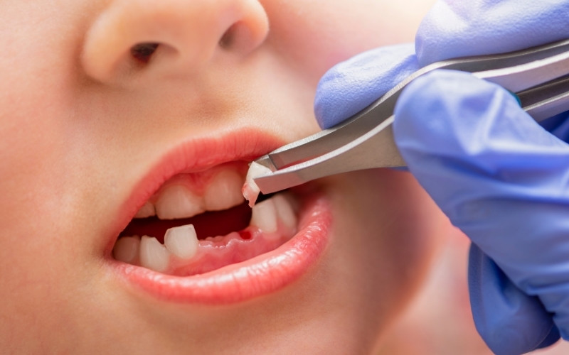 How To Fill Gap After Tooth Extraction