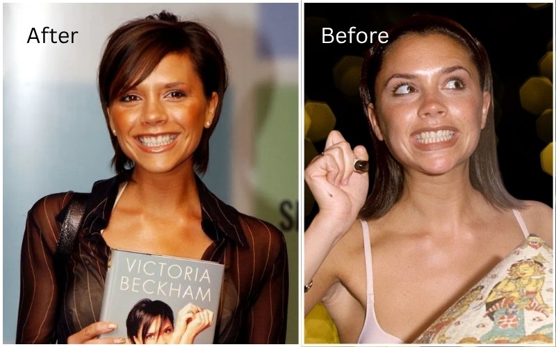 Victoria backham before after