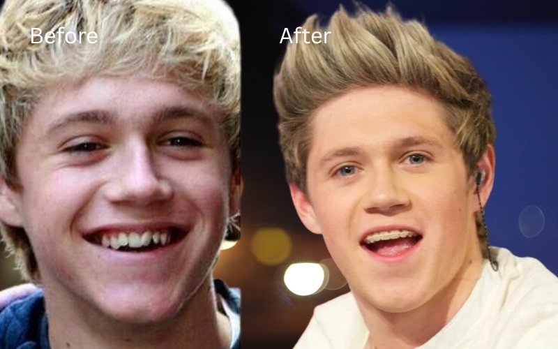 niall horan teeth