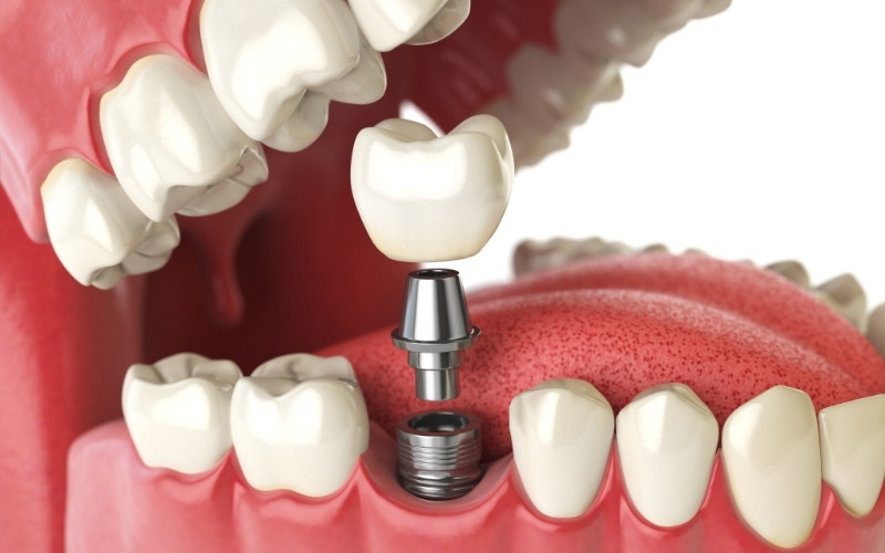Disadvantages Of Mini Dental Implants