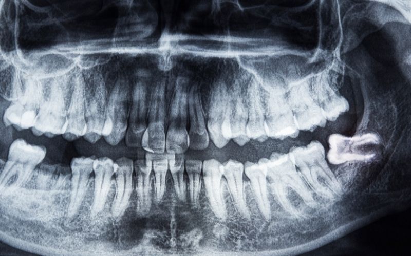 How Long Does It Take A Wisdom Tooth To Come In Once It Starts