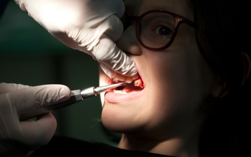 Can an infected tooth be extracted