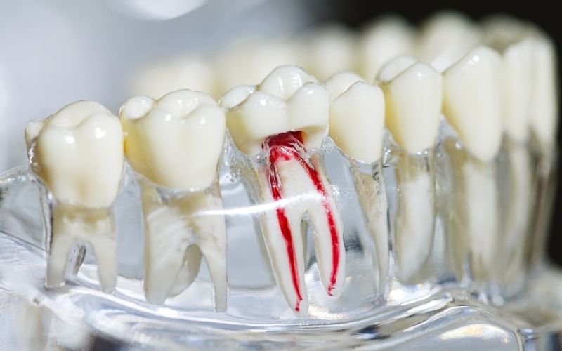How to recognize failed root canal treatment