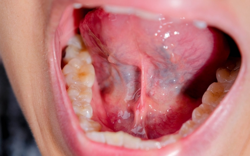 What is Palate Swelling