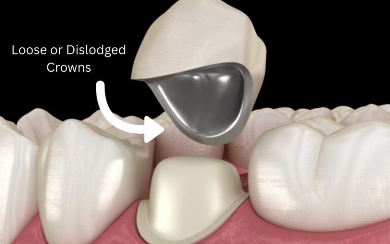 Loose or Dislodged Crowns