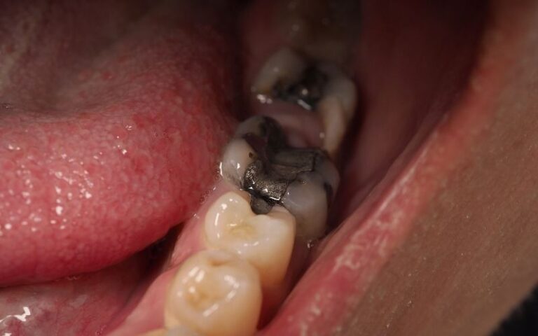 Tooth Decay Under Crowns