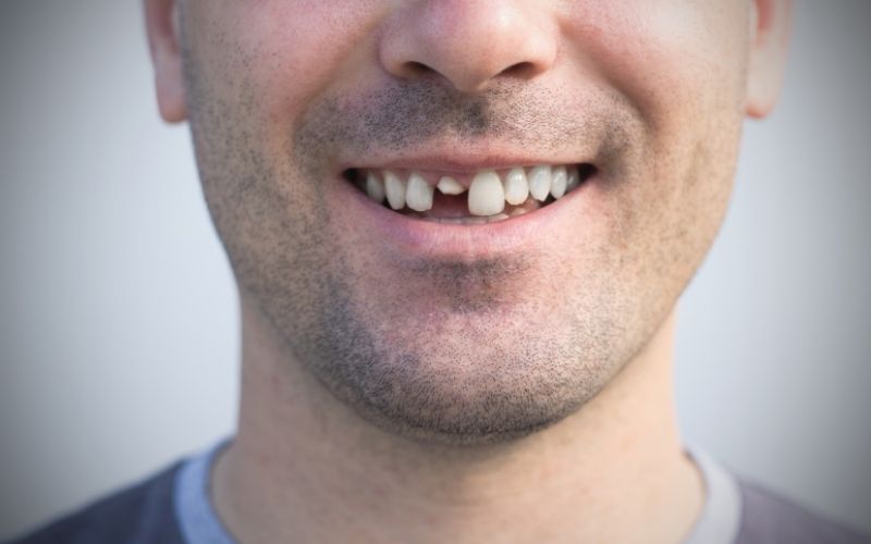 Why do teeth break