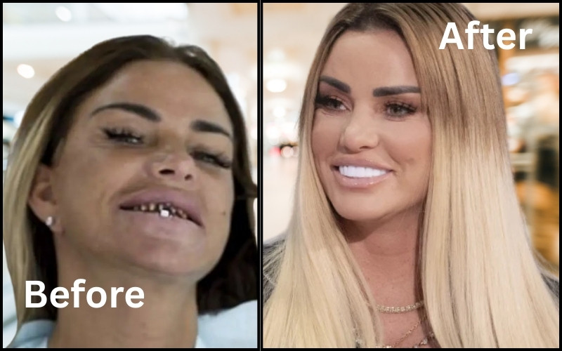 Katie Price Teeth Before & After Transformation