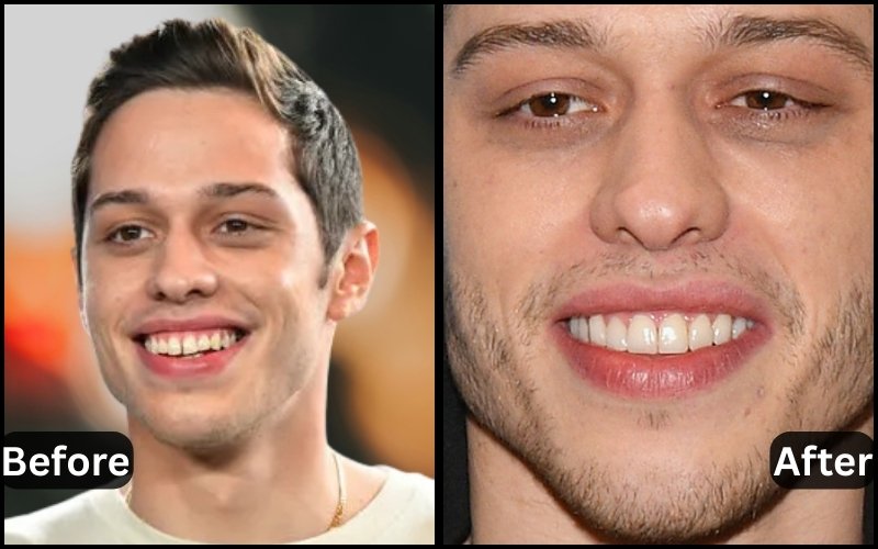 Pete Davidson Teeth Before and After