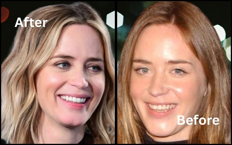 Emily Blunt Veneers Before & After